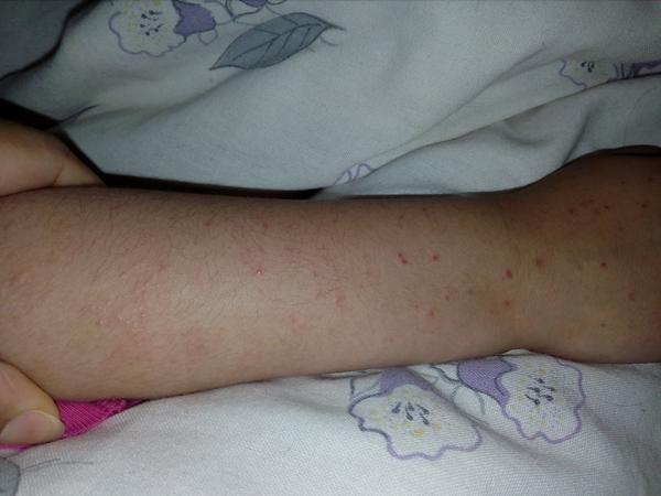 Má moja dcérka ekzém?