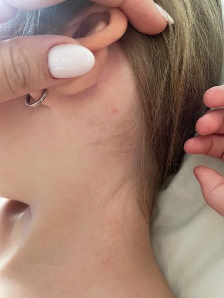 Môžu z tohto byť kiahne?