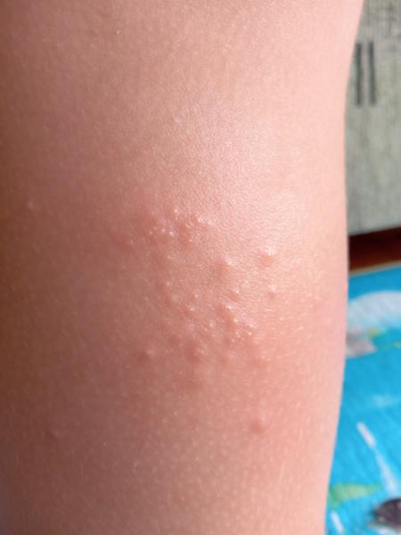 Má 5-ročná dcéra kiahne?