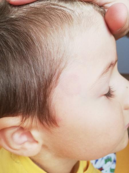 Aké vyrážky má môj syn po očkovaní v 5. rokoch?