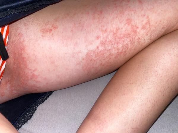 Červená pokožka na zadku, stehnách a v podpazuší