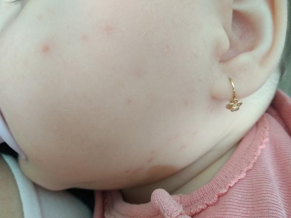 Čo môžu byť tieto vyrážky ? 