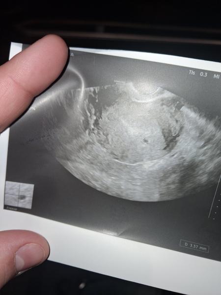 Máte skúsenosti s posunutou ovuláciou a nepravidelným cyklom?