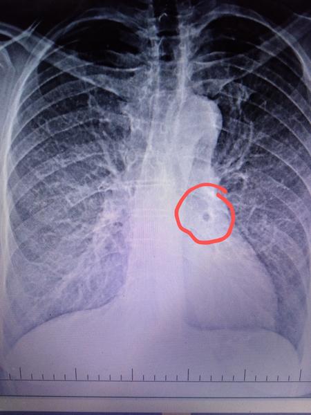 RTG pľúc: Dôležitosť a využitie v medicíne