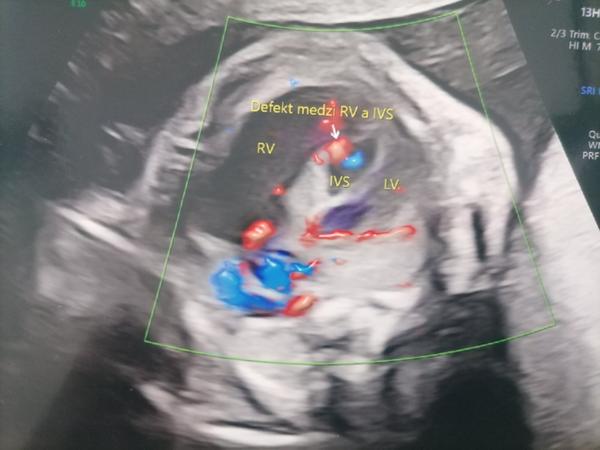 Čo hrozí môjmu bábätku?