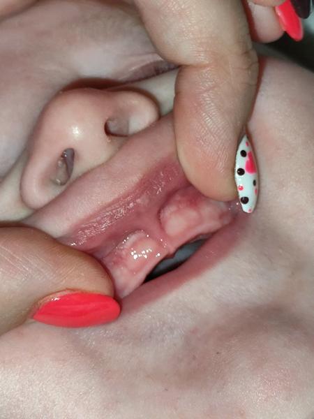 Ako dlho trvá bolestivé prerezávanie zúbkov?