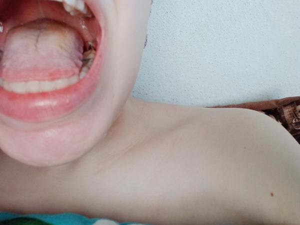 Je bolesť po extrakcii zuba múdrosti normálna aj po dlhšej dobe?