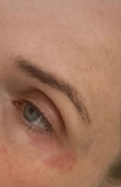 Pomôže čínska medicína na vyrážky pod očami?