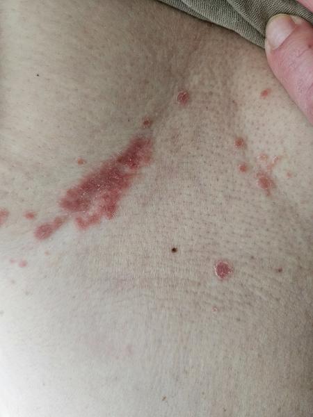 Čo spôsobuje kožné problémy na tele?