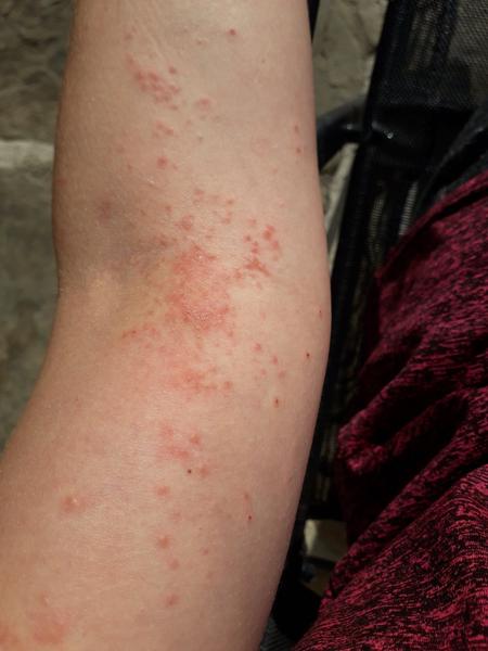 Z čoho mám takto vyhádzanú ruku?