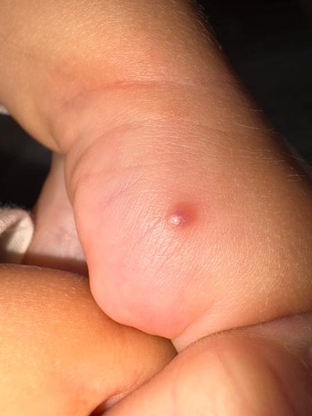 Vyrážka na ruke dieťaťa