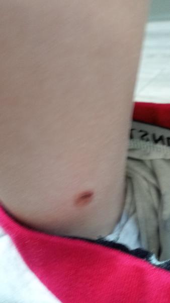 Čo to môže byť za vyrážky?