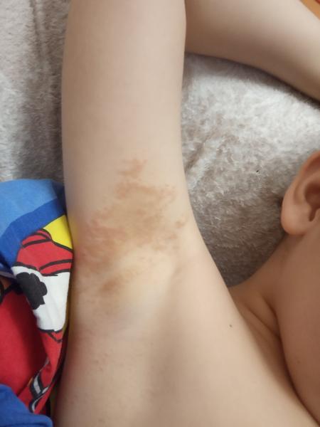 Aké vyrážky v oblasti pazúch má môj 7 ročný syn?