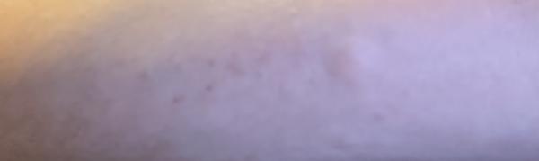 Sú to štípance od ploštice?