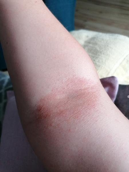 Aký výsyp to mám v 6. týždni tehotenstva?