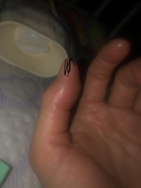 Príčiny opuchu a bolesti palca na ruke?