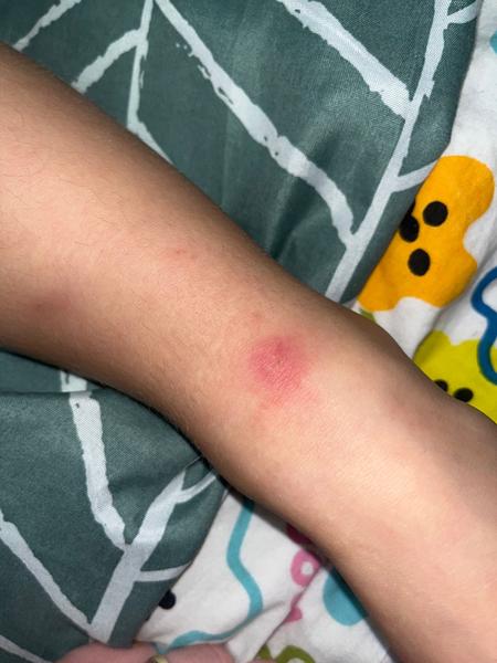 Od akého hmyzu môže byť tento štípanec?