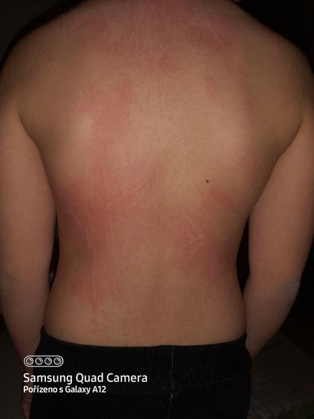 Žihlavka verzus alergia