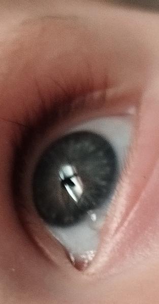 Priesvitná bublinka v oku