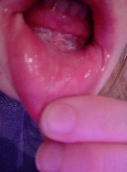 Ako sa zbavíme infekcie v ústach?