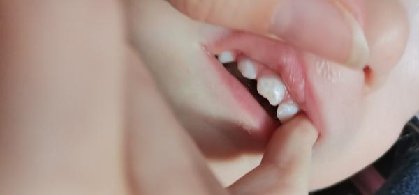 Má dcérka na odštiepenom zúbku kaz?