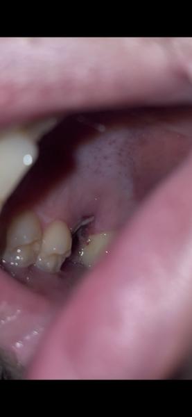 Som po extrakcii zubu s komplikáciami a bolesťou