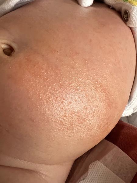 Može to byť ekzém u 2-mesačného dieťaťa?