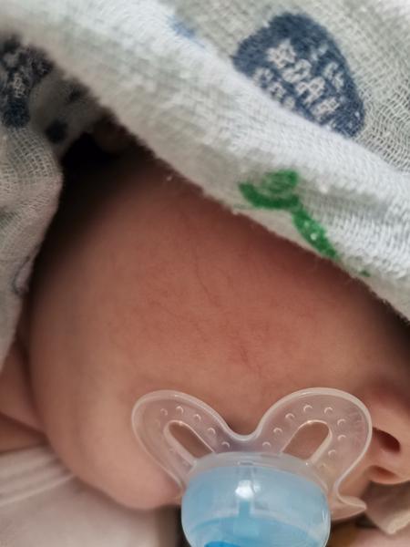 Žilky na tváričke 2-mesačného bábätka