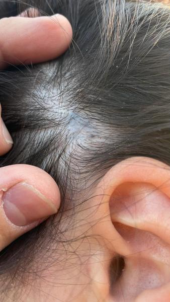 Čierna pokožka na hlave: čo môže byť príčina?