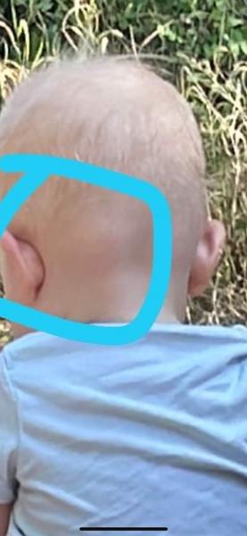 Hrčka na hlavičke 10-mesačného