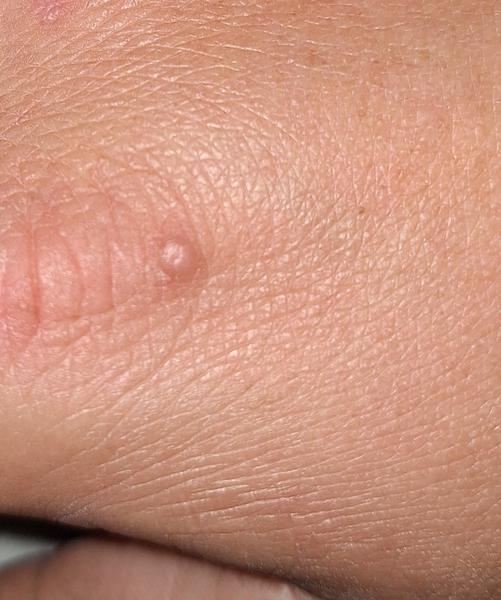 Je toto skutočne bradavica?