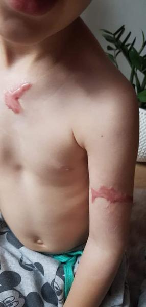 Dá sa odstrániť 4 cm vyčnievajúca jazva po obarení vodou?