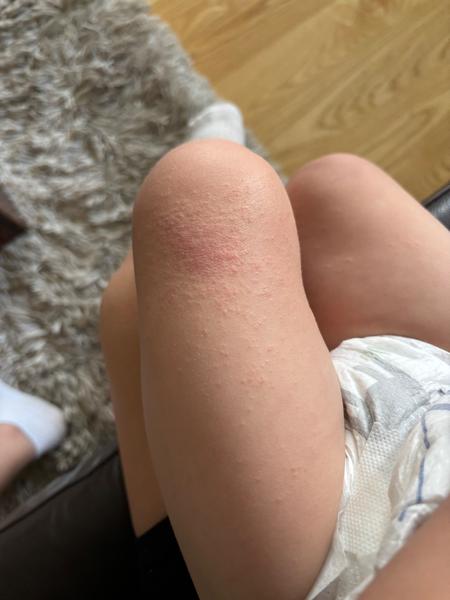 Je vyrážka na koži dôsledkom alergie alebo dermatitídy?