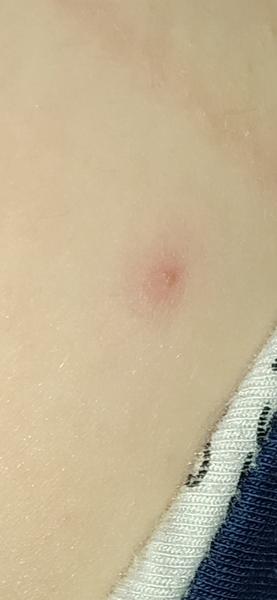 Čo spôsobuje výsev vyrážok?