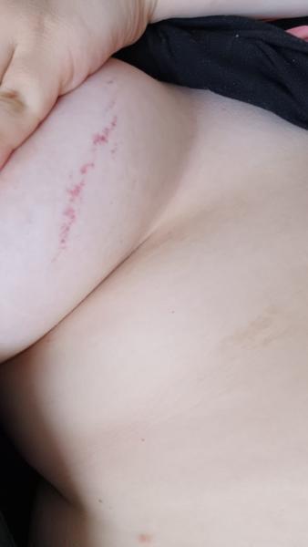 Čo spôsobuje podliatinky na prsiach počas tehotenstva?