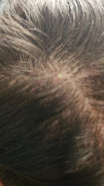 Hnisavé vyrážky vo vlasoch