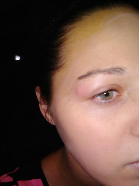 Prečo mi opuchla vyrážka, ktorú som si chytala?