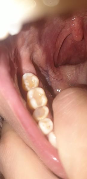 Ako postupovať pri liečbe jamky v ústach?