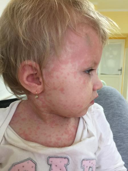Červené vyrážky po celom tele