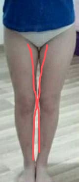 Pri kolenách sa mi trie koža