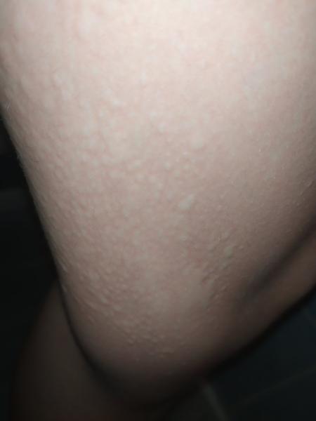 Týždeň sa mi robia takéto vyrážky, čo to môže byť ? 