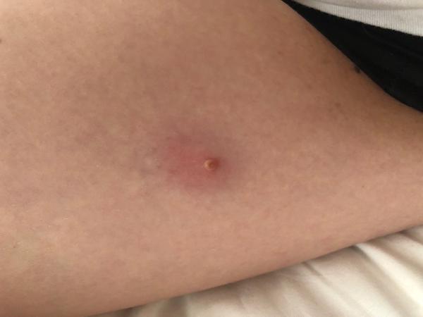 Čo na začervenané okolie znamienka?