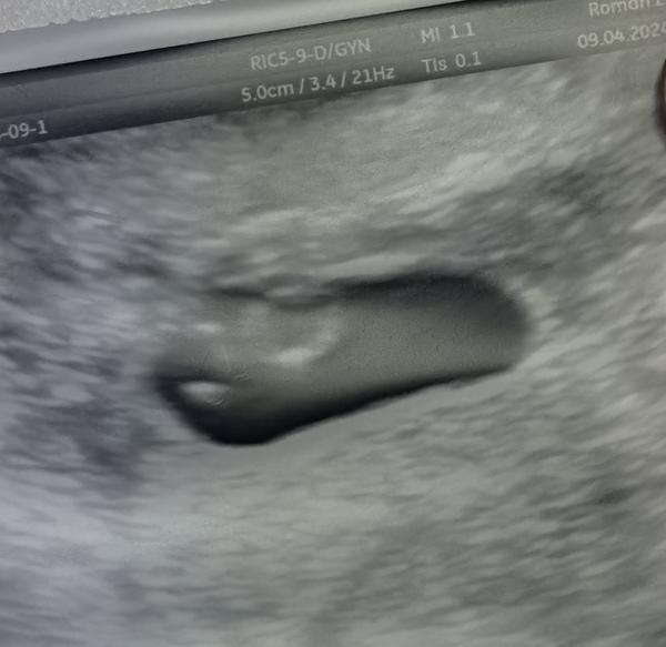 Budú to naozaj dvojičky? Skúsenosti ostatných