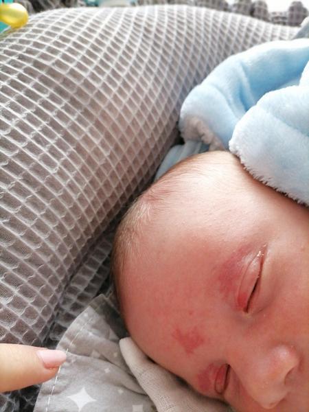 Týždňové dieťatko má hemangióm