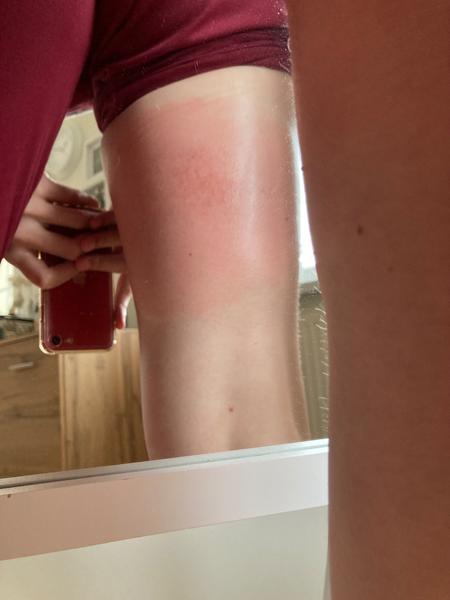 Uštipnutie hmyzom - fľak