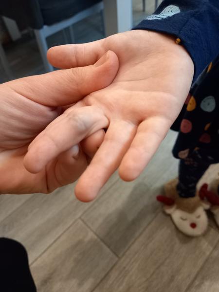 Ako liečiť opuch článku prstu?