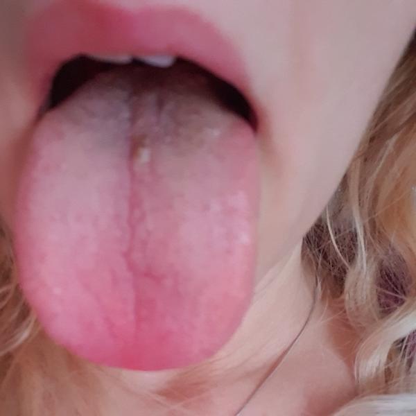 Zmeny na jazyku - možná rakovina