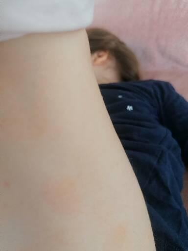 Kožný problém - fľaky u dieťaťa