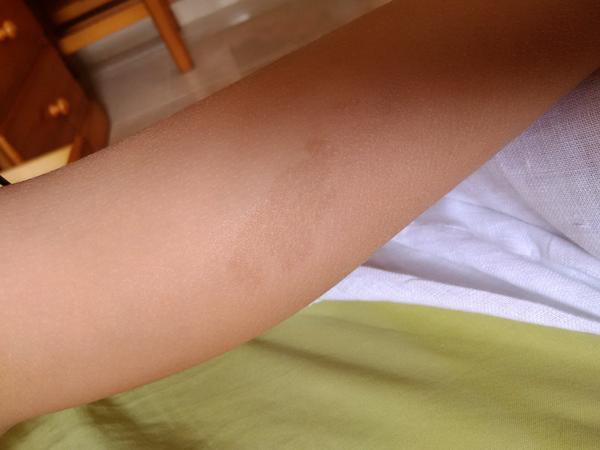 Je to pigmentový fľak na nohe mojej dcéry?