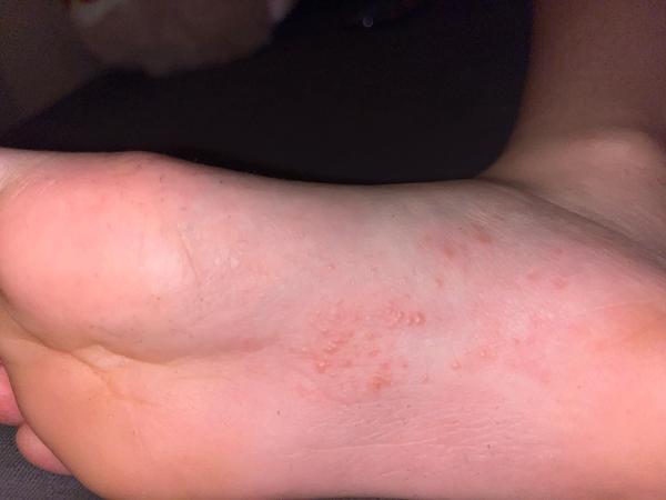 Čo môžu znamenať vyrážky na nohe u detí?